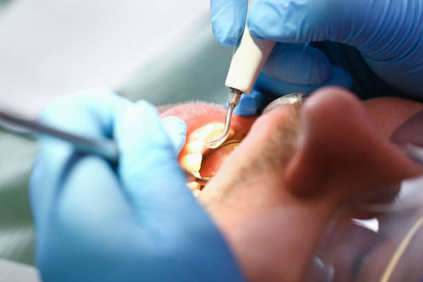 Best Emergency Treatment for Dental Infections or Abscesses in Beattystown, NJ